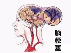 養(yǎng)成好的生活習(xí)慣，能夠有效預(yù)防腦梗塞